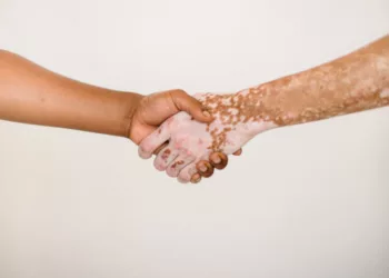 Vitiligo